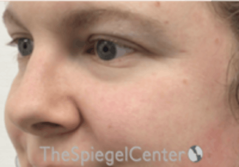 Cheek Implants Before & After Gallery - Patient 402198 - Image 1