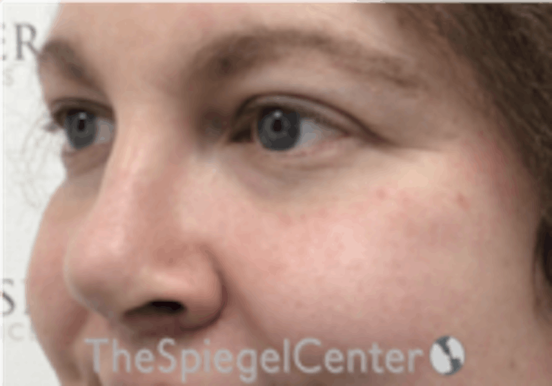 Cheek Implants Before & After Gallery - Patient 402198 - Image 2