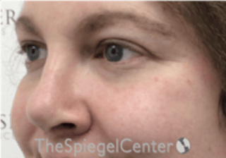 Cheek Implants Before & After Gallery - Patient 402198 - Image 2