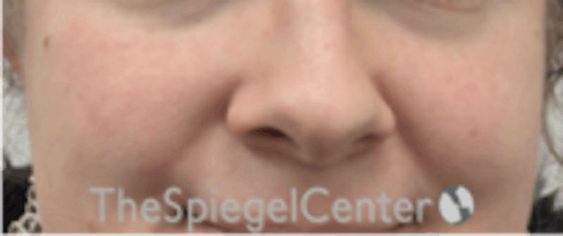 Cheek Implants Before & After Gallery - Patient 402198 - Image 3