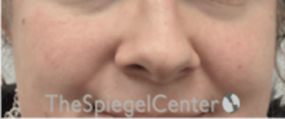 Cheek Implants Before & After Gallery - Patient 402198 - Image 3