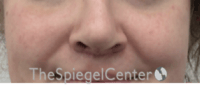 Cheek Implants Before & After Gallery - Patient 402198 - Image 4