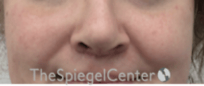 Cheek Implants Before & After Gallery - Patient 402198 - Image 4