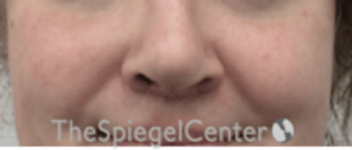 Cheek Implants Before & After Gallery - Patient 402198 - Image 4