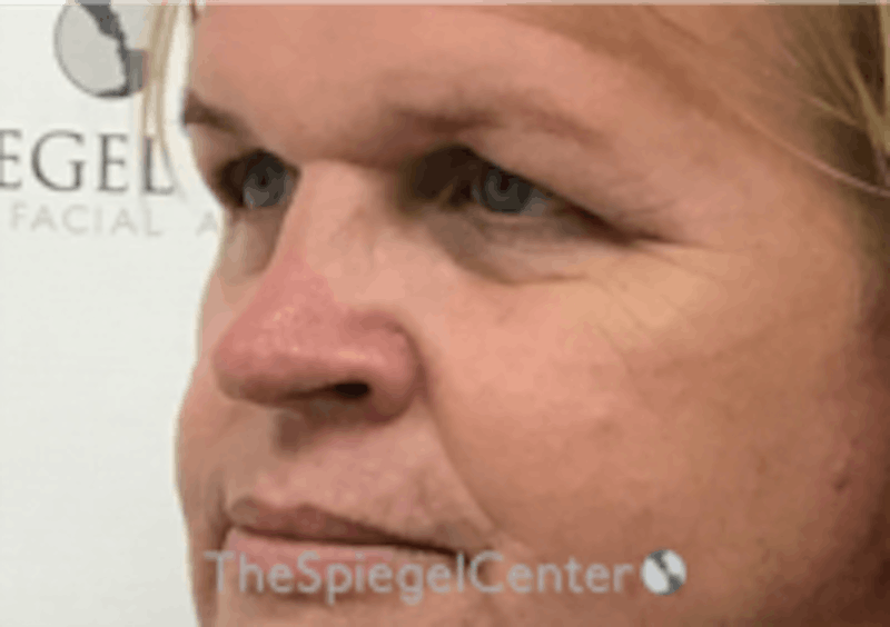 Cheek Implants Before & After Gallery - Patient 213721 - Image 1
