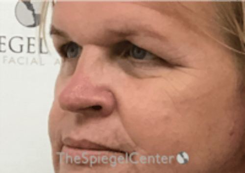 Cheek Implants Before & After Gallery - Patient 213721 - Image 1