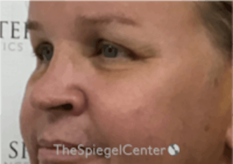 Cheek Implants Before & After Gallery - Patient 213721 - Image 2