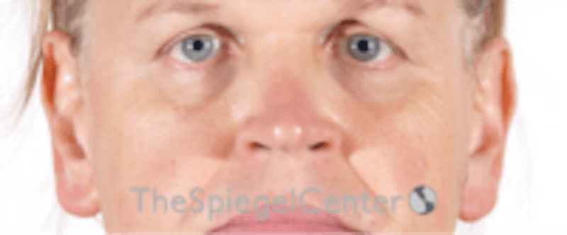 Cheek Implants Before & After Gallery - Patient 213721 - Image 3