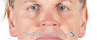 Cheek Implants Before & After Gallery - Patient 213721 - Image 3