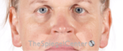 Cheek Implants Before & After Gallery - Patient 213721 - Image 3