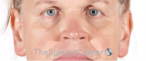 Cheek Implants Before & After Gallery - Patient 213721 - Image 3
