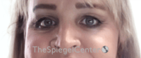 Cheek Implants Before & After Gallery - Patient 213721 - Image 4
