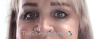 Cheek Implants Before & After Gallery - Patient 213721 - Image 4