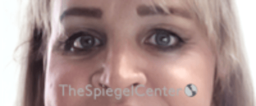 Cheek Implants Before & After Gallery - Patient 213721 - Image 4