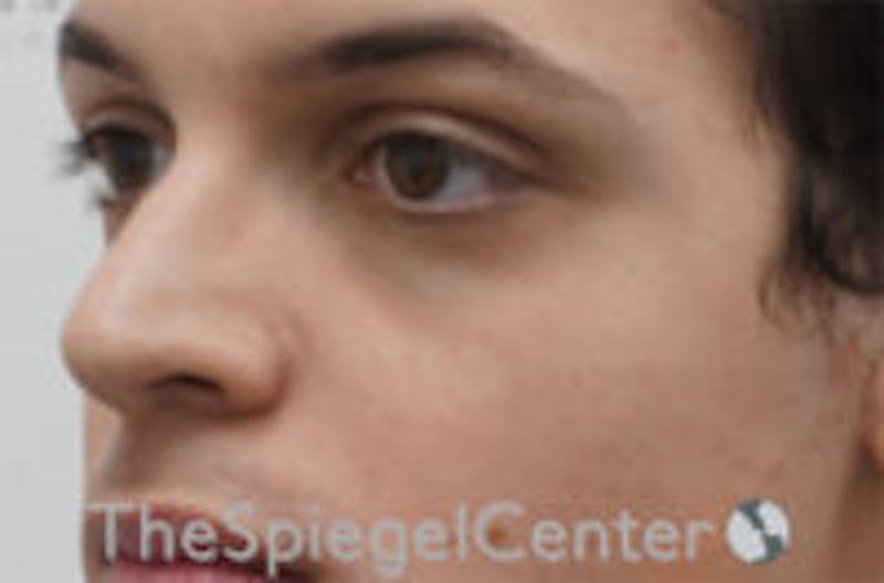 Cheek Implants Before & After Gallery - Patient 156982 - Image 1