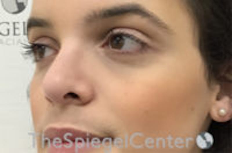 Cheek Implants Before & After Gallery - Patient 156982 - Image 2