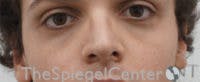Cheek Implants Before & After Gallery - Patient 156982 - Image 3