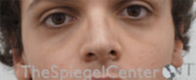 Cheek Implants Before & After Gallery - Patient 156982 - Image 3