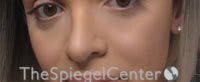 Cheek Implants Before & After Gallery - Patient 156982 - Image 4