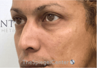 Cheek Implants Before & After Gallery - Patient 316923 - Image 1