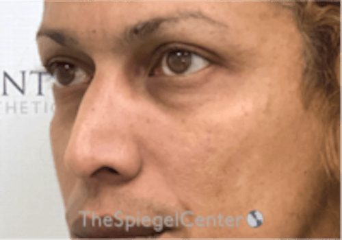 Cheek Implants Before & After Gallery - Patient 316923 - Image 1
