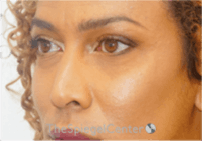 Cheek Implants Before & After Gallery - Patient 316923 - Image 2