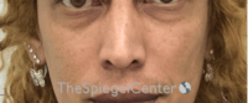 Cheek Implants Before & After Gallery - Patient 316923 - Image 3