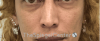 Cheek Implants Before & After Gallery - Patient 316923 - Image 3