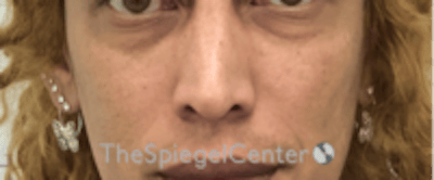 Cheek Implants Before & After Gallery - Patient 316923 - Image 3