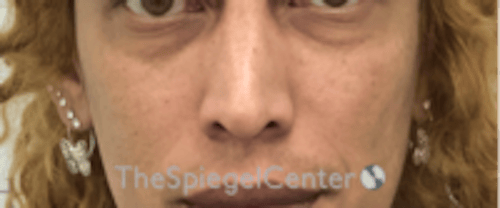 Cheek Implants Before & After Gallery - Patient 316923 - Image 3
