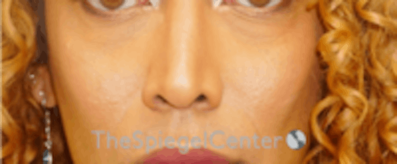 Cheek Implants Before & After Gallery - Patient 316923 - Image 4