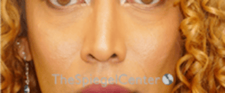 Cheek Implants Before & After Gallery - Patient 316923 - Image 4