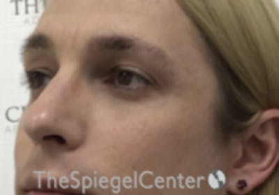 Cheek Implants Before & After Gallery - Patient 100470 - Image 1