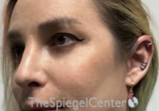 Cheek Implants Before & After Gallery - Patient 100470 - Image 2