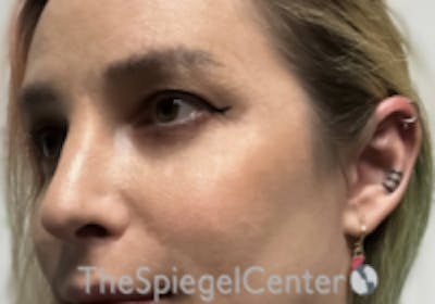 Cheek Implants Before & After Gallery - Patient 100470 - Image 2