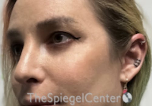 Cheek Implants Before & After Gallery - Patient 100470 - Image 2