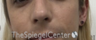 Cheek Implants Before & After Gallery - Patient 100470 - Image 3