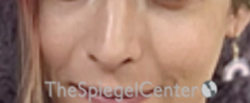 Cheek Implants Before & After Gallery - Patient 100470 - Image 4