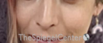 Cheek Implants Before & After Gallery - Patient 100470 - Image 4