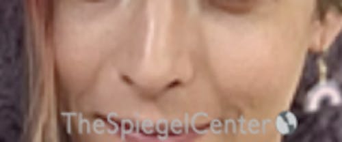 Cheek Implants Before & After Gallery - Patient 100470 - Image 4