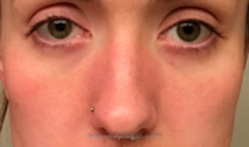 Cheek Implants Before & After Gallery - Patient 222303 - Image 1