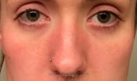 Cheek Implants Before & After Gallery - Patient 222303 - Image 1
