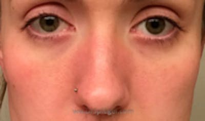 Cheek Implants Before & After Gallery - Patient 222303 - Image 1