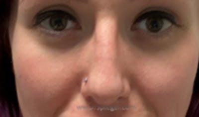 Cheek Implants Before & After Gallery - Patient 222303 - Image 2