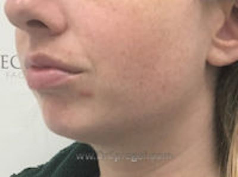 Chin Augmentation Before & After Gallery - Patient 103837 - Image 3