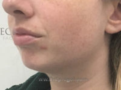 Chin Augmentation Before & After Gallery - Patient 103837 - Image 3