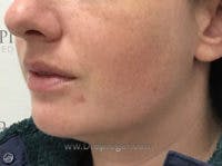 Chin Augmentation Before & After Gallery - Patient 103837 - Image 4