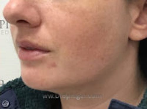 Chin Augmentation Before & After Gallery - Patient 103837 - Image 4
