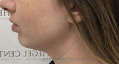 Chin Augmentation Before & After Gallery - Patient 103837 - Image 5