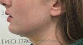 Chin Augmentation Before & After Gallery - Patient 103837 - Image 6